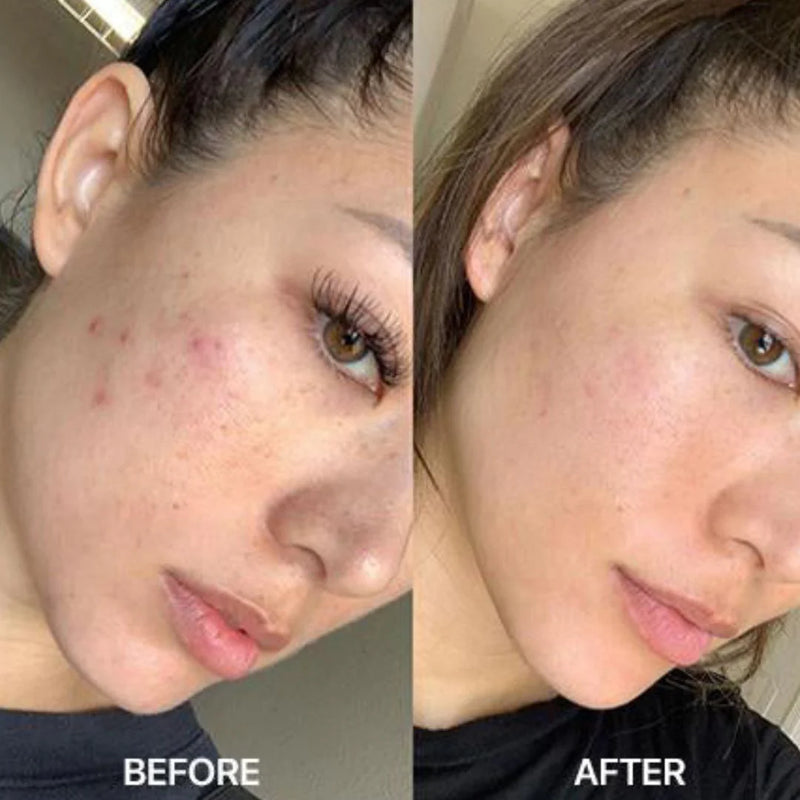 Nuvio High Frequency Acne Wand